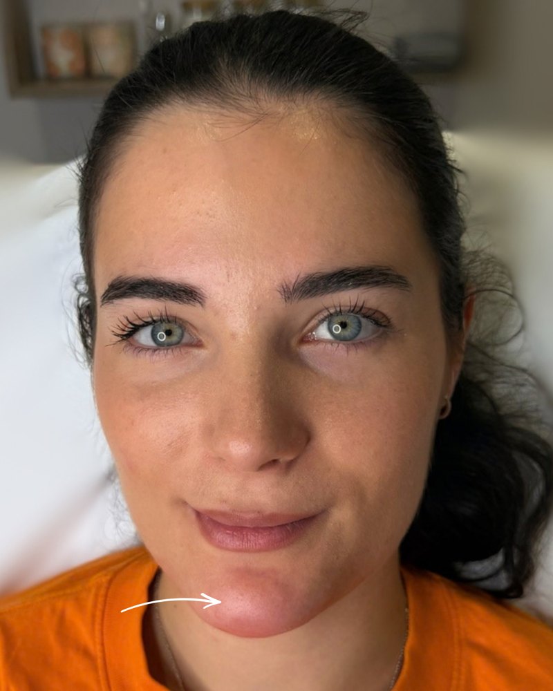 Client after chin filler