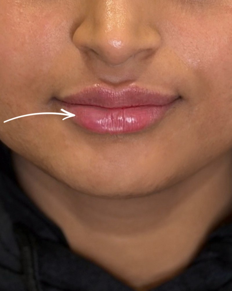 Client lips after treatment