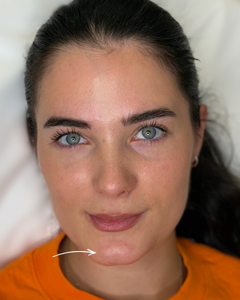 Client before chin filler