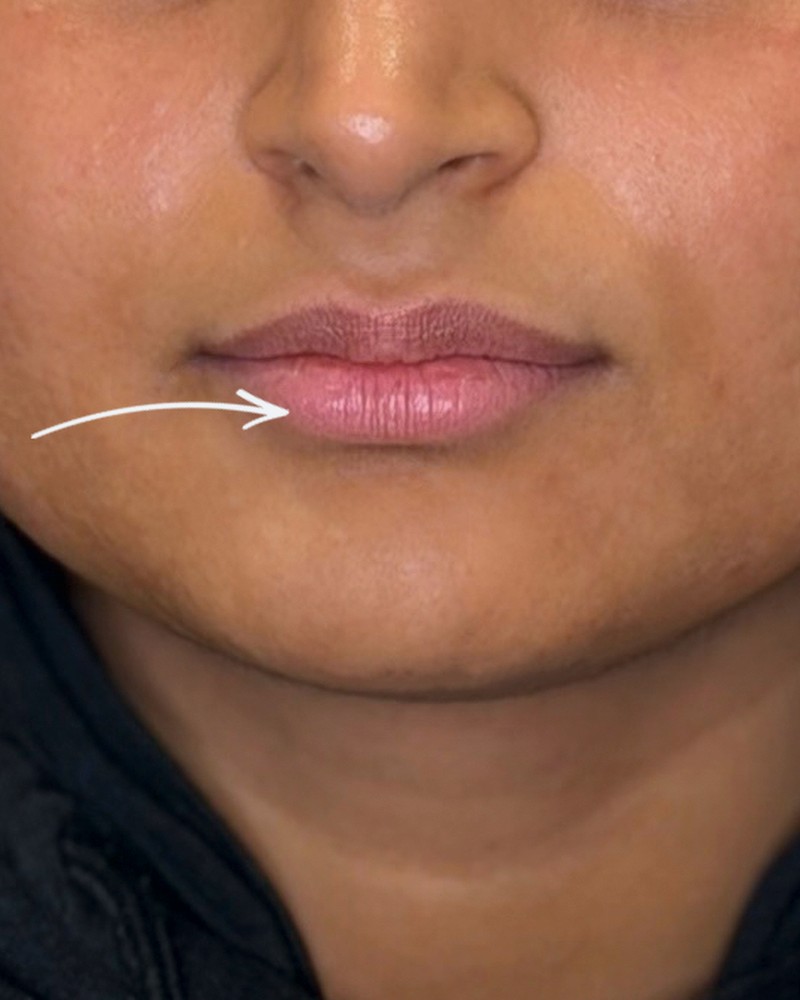 Client lips before treatment